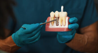 How Do Dental Implants Strengthen Your Smile?