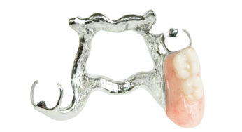 How We Craft Your Partial Dentures