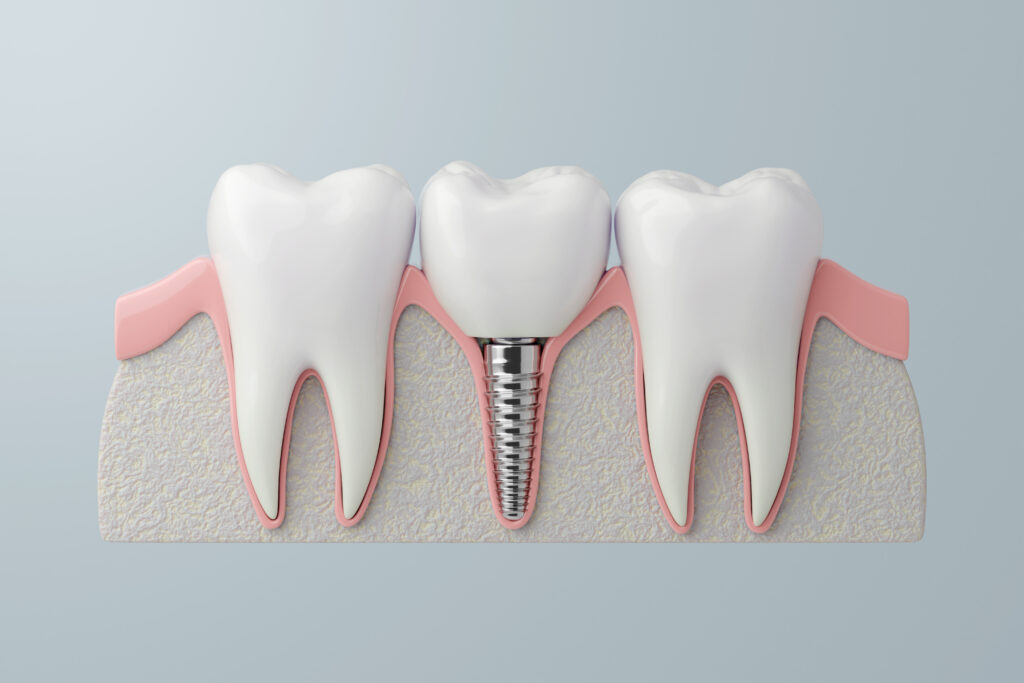 grand prairie dental implants