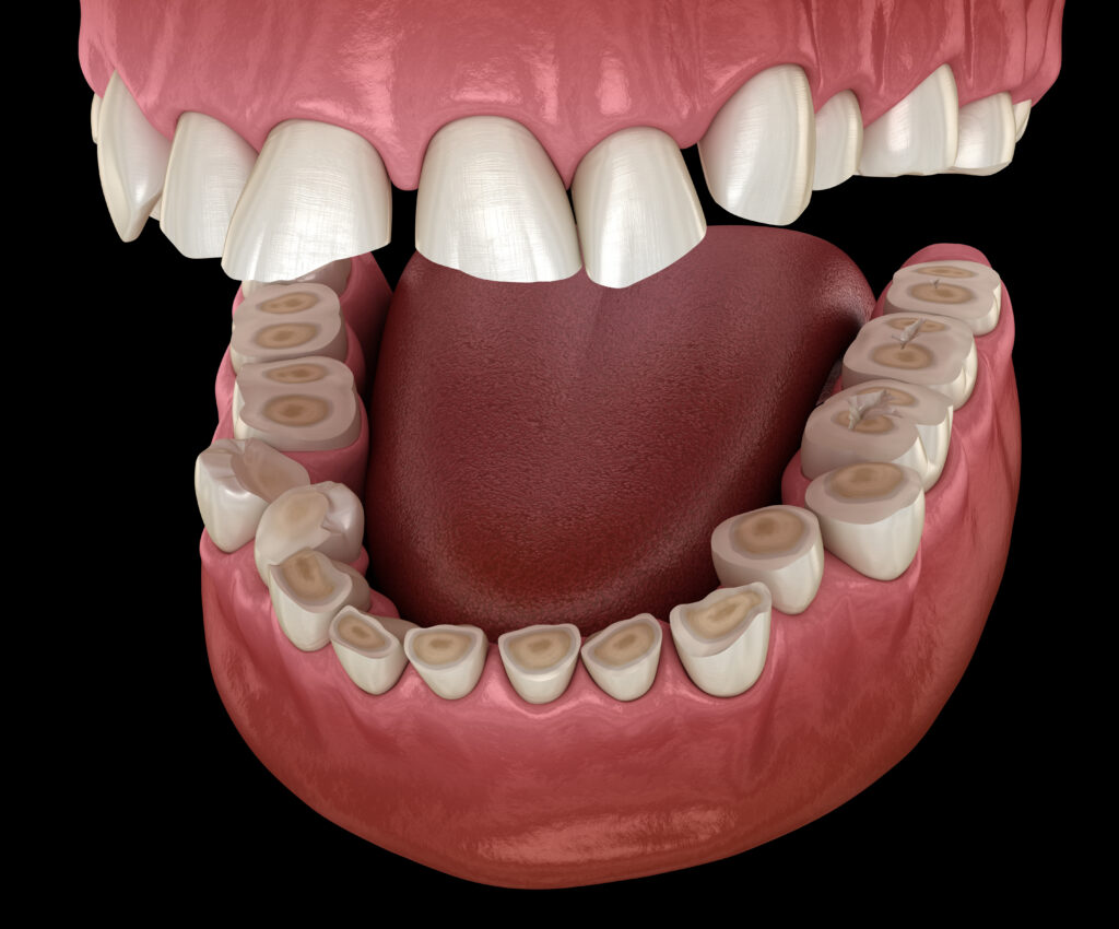 grand prairie teeth grinding